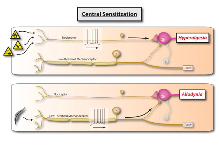 Central sensitization: Implications for the diagnosis and treatment of pain
