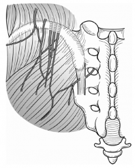 Entrapment of middle cluneal nerves as an unknown cause of low back pain